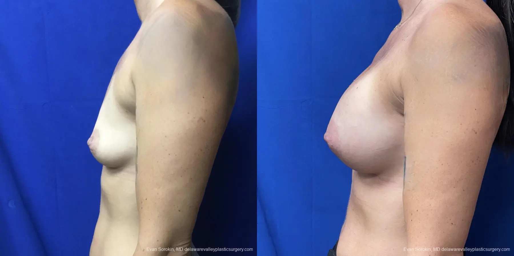 Breast Augmentation: Patient 202 - Before and After 3