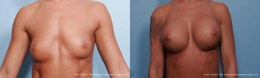 Philadelphia Breast Augmentation 9299 - Before and After 1