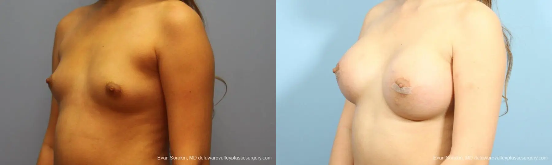 Philadelphia Breast Augmentation 9194 - Before and After 4