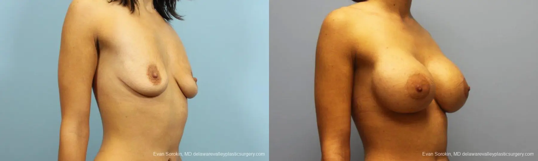 Philadelphia Breast Augmentation 9205 - Before and After 2