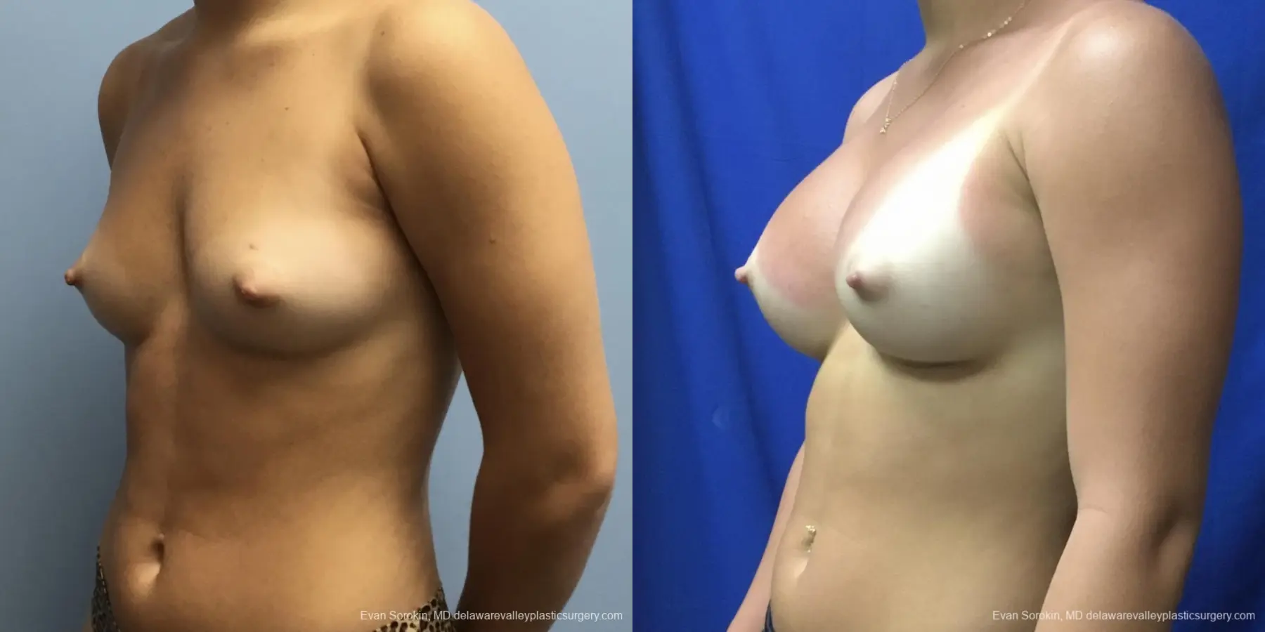 Breast Augmentation: Patient 166 - Before and After 4