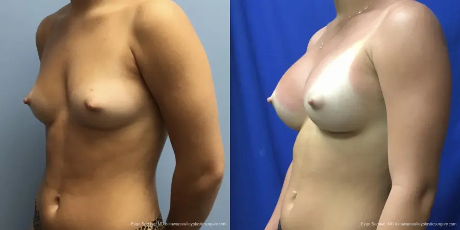 Breast Augmentation: Patient 191 - Before and After 4