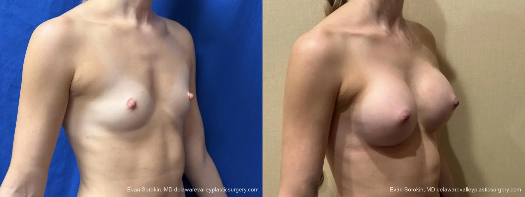 Breast Augmentation: Patient 267 - Before and After 2