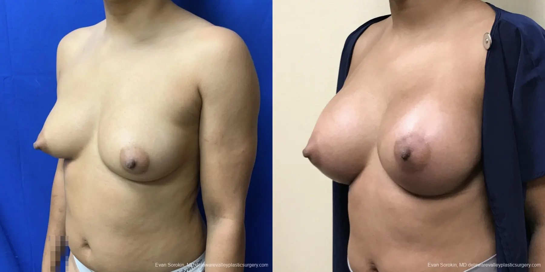 Breast Augmentation: Patient 205 - Before and After 2