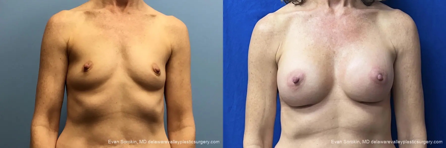 Breast Augmentation: Patient 6 - Before and After 1