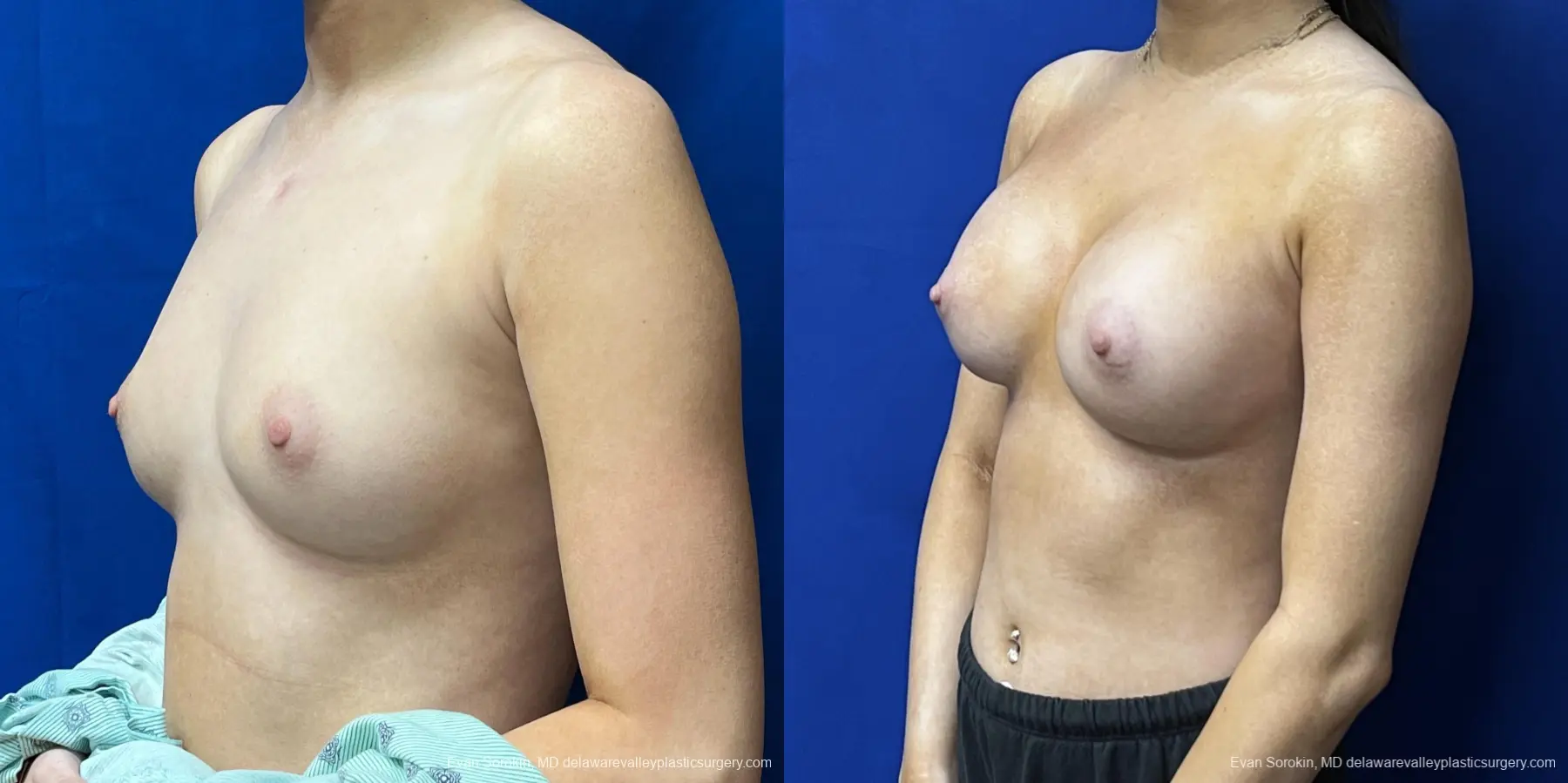 Breast Augmentation: Patient 215 - Before and After 4