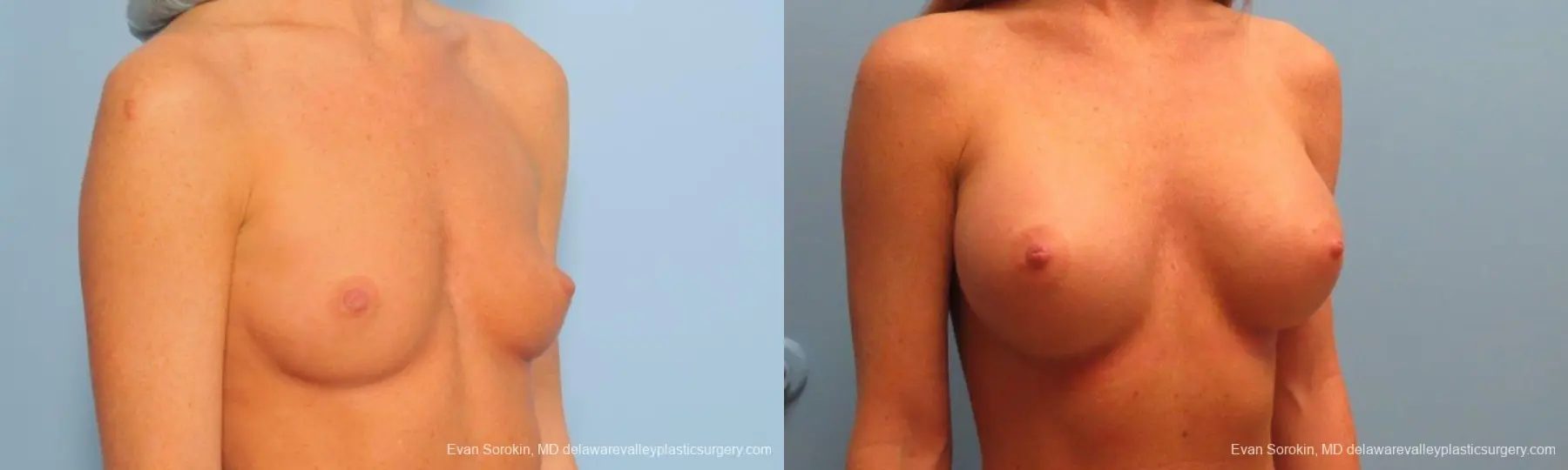Philadelphia Breast Augmentation 9179 - Before and After 2