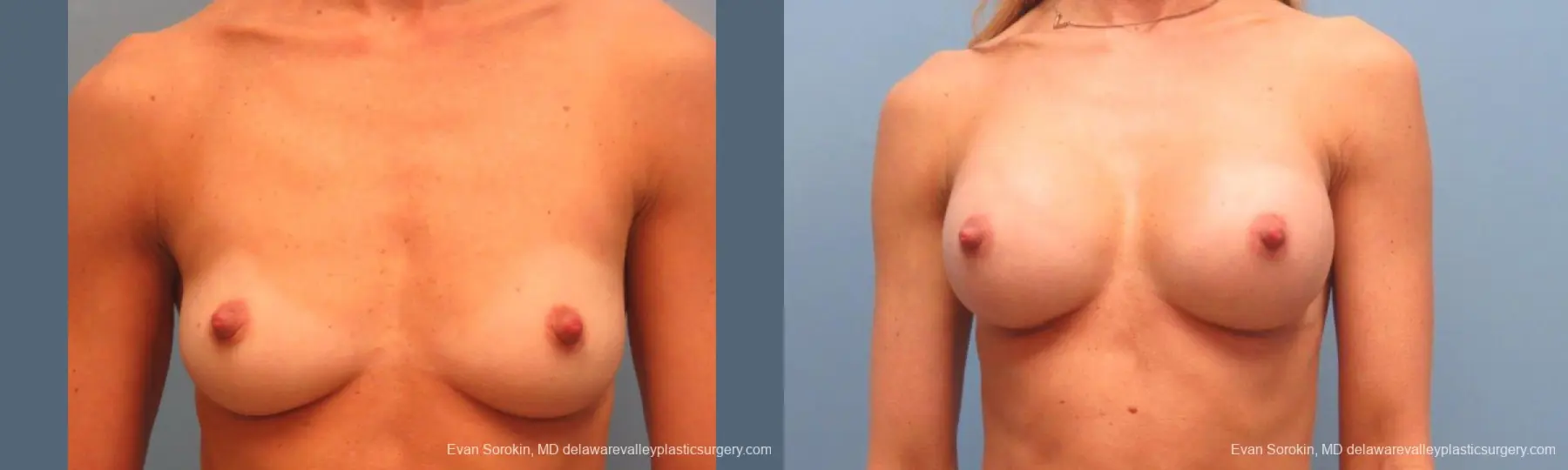 Philadelphia Breast Augmentation 9396 - Before and After 1