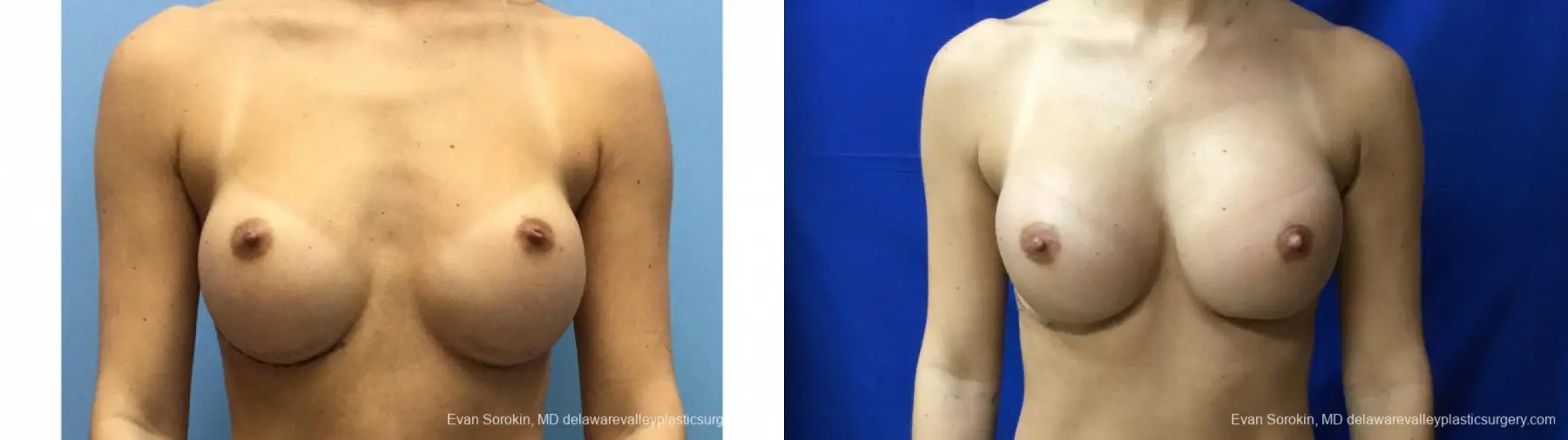 Philadelphia Breast Augmentation 13177 - Before and After