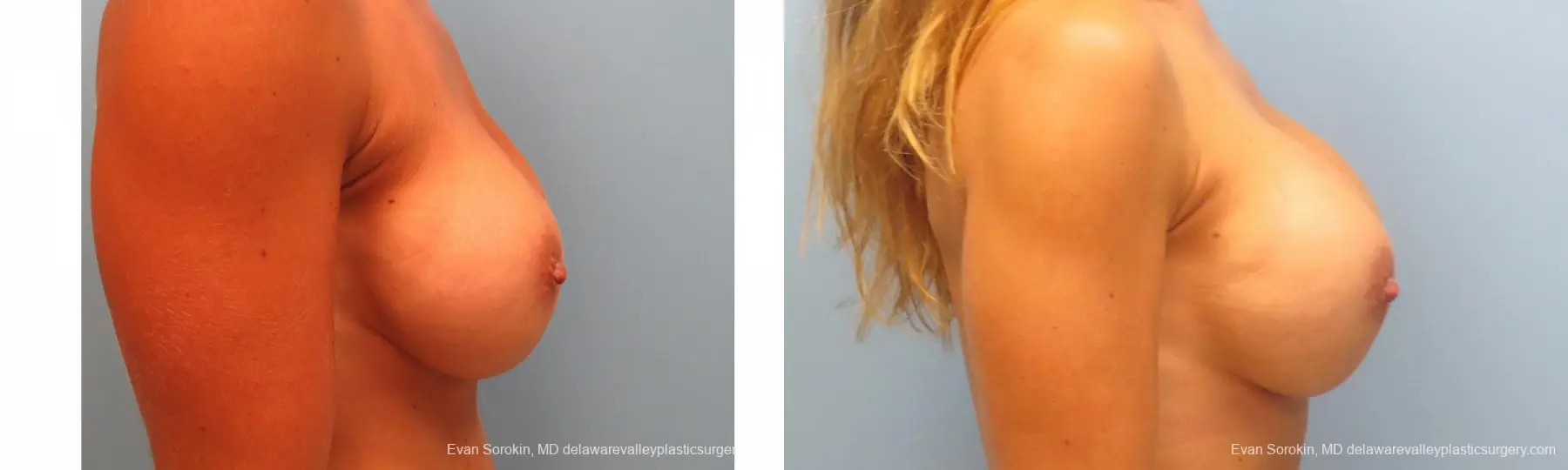 Breast Augmentation Revision: Patient 10 - Before and After 5
