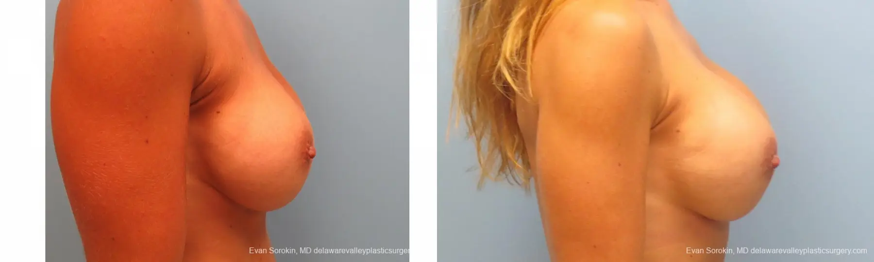 Breast Augmentation: Patient 113 - Before and After 5