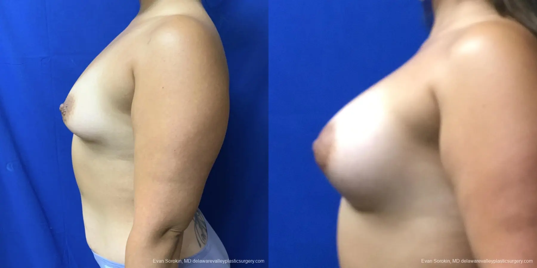 Breast Augmentation: Patient 208 - Before and After 5