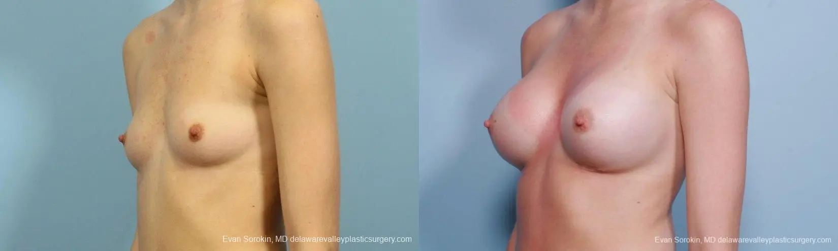 Philadelphia Breast Augmentation 8660 - Before and After 3