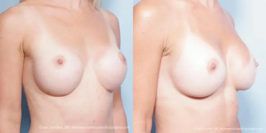 Philadelphia Breast Augmentation 8652 - Before and After 2