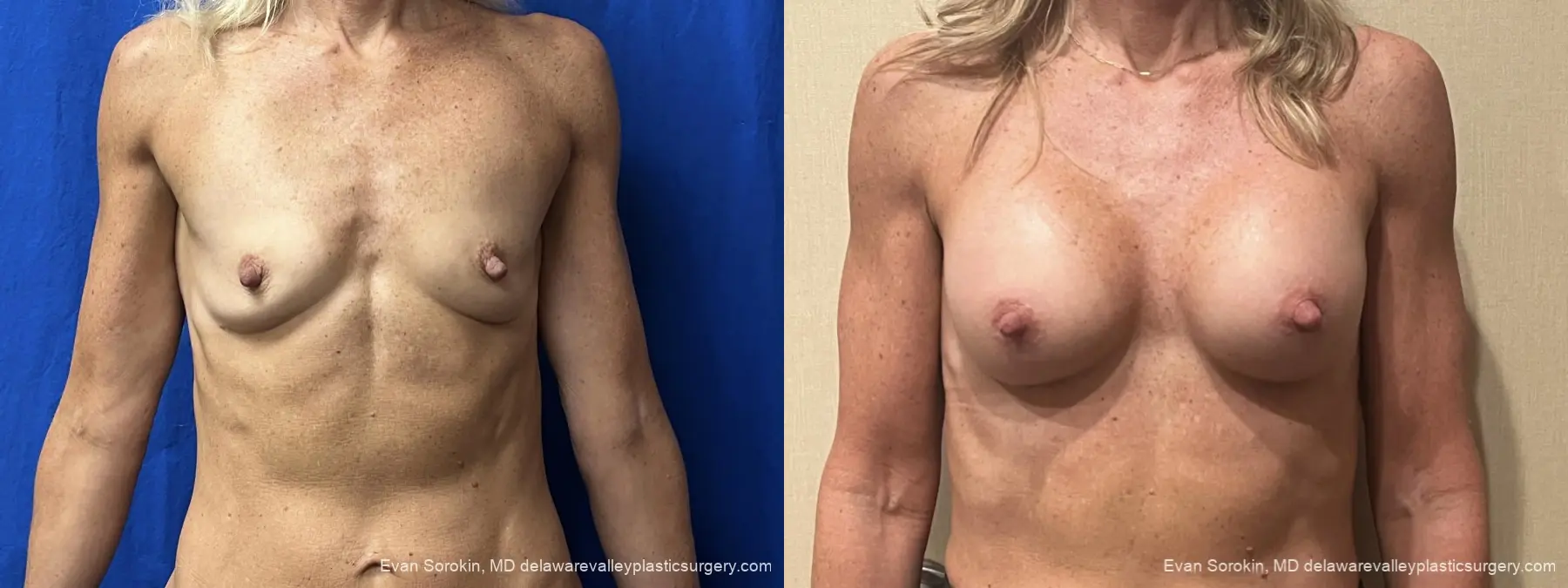 Breast Augmentation: Patient 319 - Before and After 1