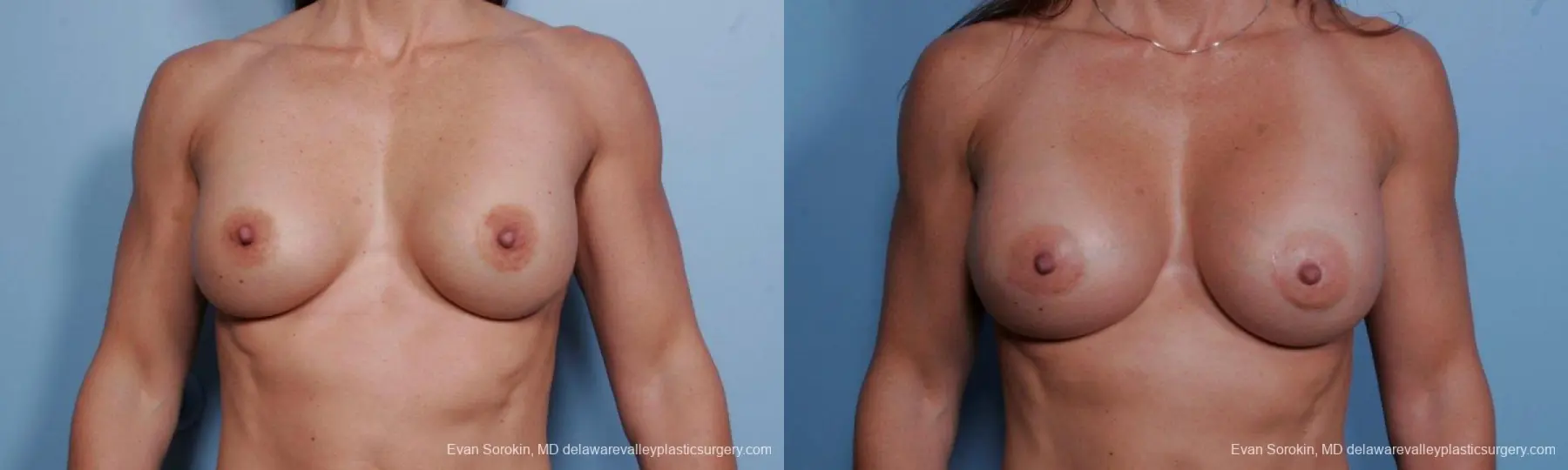 Philadelphia Breast Augmentation 9455 - Before and After 1