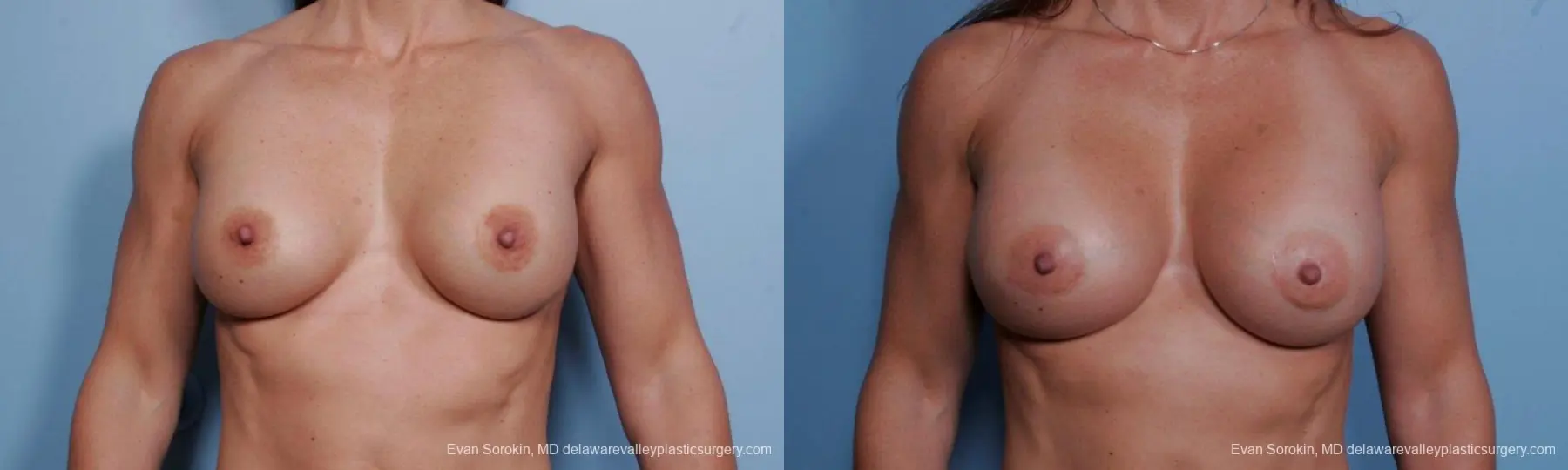 Philadelphia Breast Augmentation 9455 - Before and After