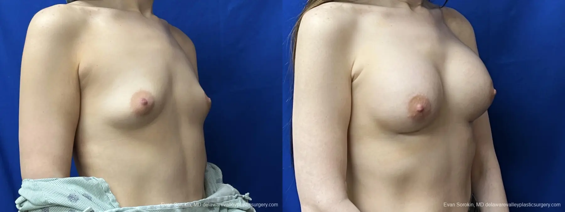 Breast Augmentation: Patient 245 - Before and After 2