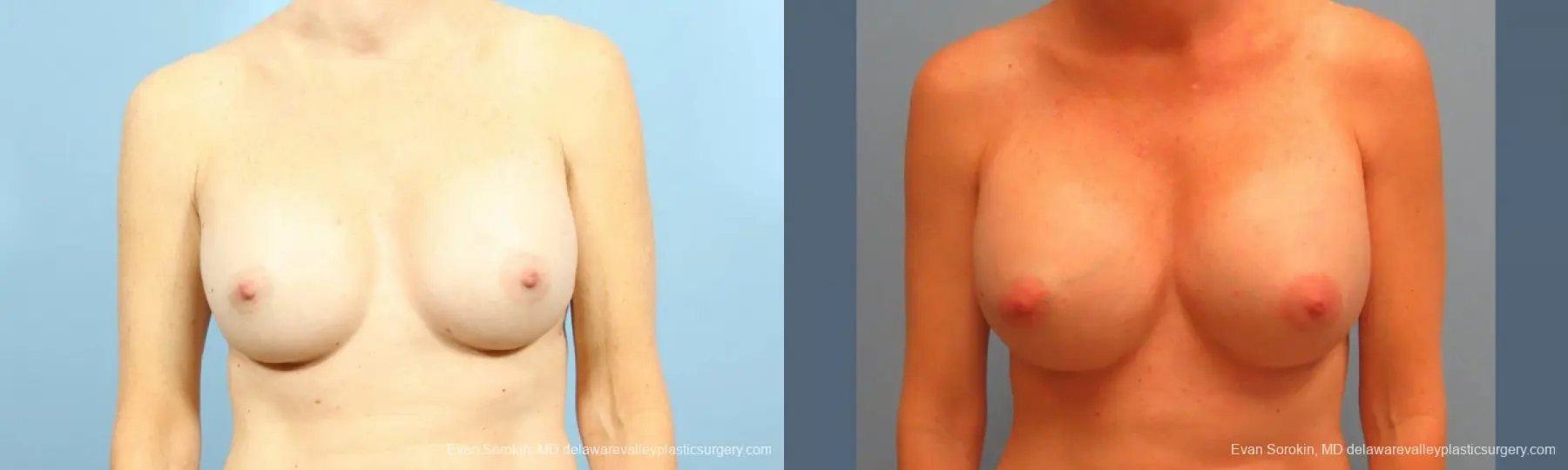 Philadelphia Breast Augmentation 9456 - Before and After 1