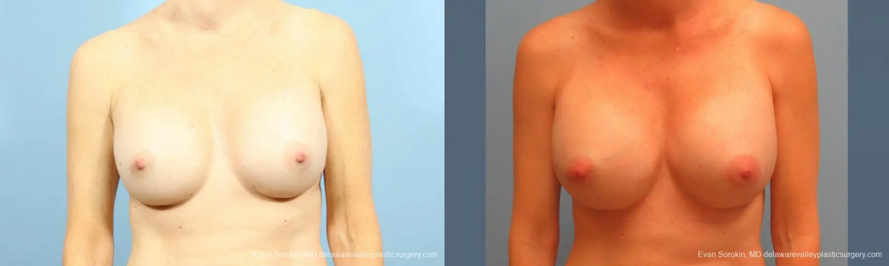 Philadelphia Breast Augmentation 9456 - Before and After