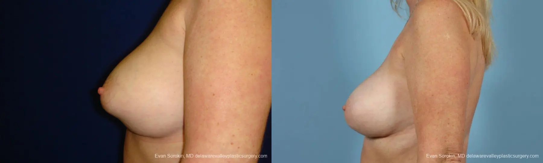 Philadelphia Breast Augmentation 9457 - Before and After 3