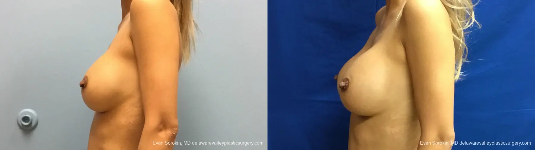 Philadelphia Breast Augmentation 13178 - Before and After 5