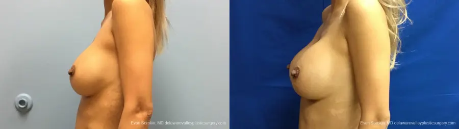 Philadelphia Breast Augmentation 13178 - Before and After 5
