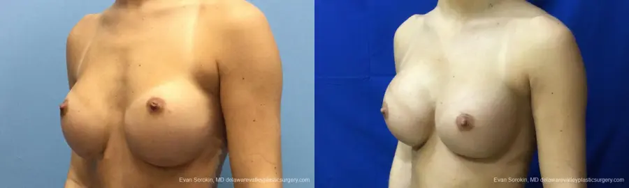 Philadelphia Breast Augmentation 10816 - Before and After 4