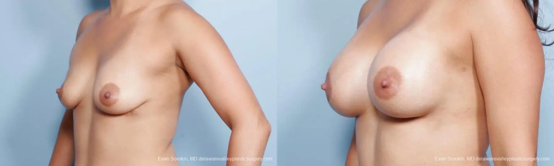 Philadelphia Breast Augmentation 9297 - Before and After 4