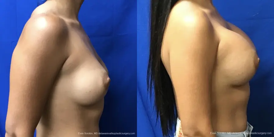 Breast Augmentation: Patient 201 - Before and After 4