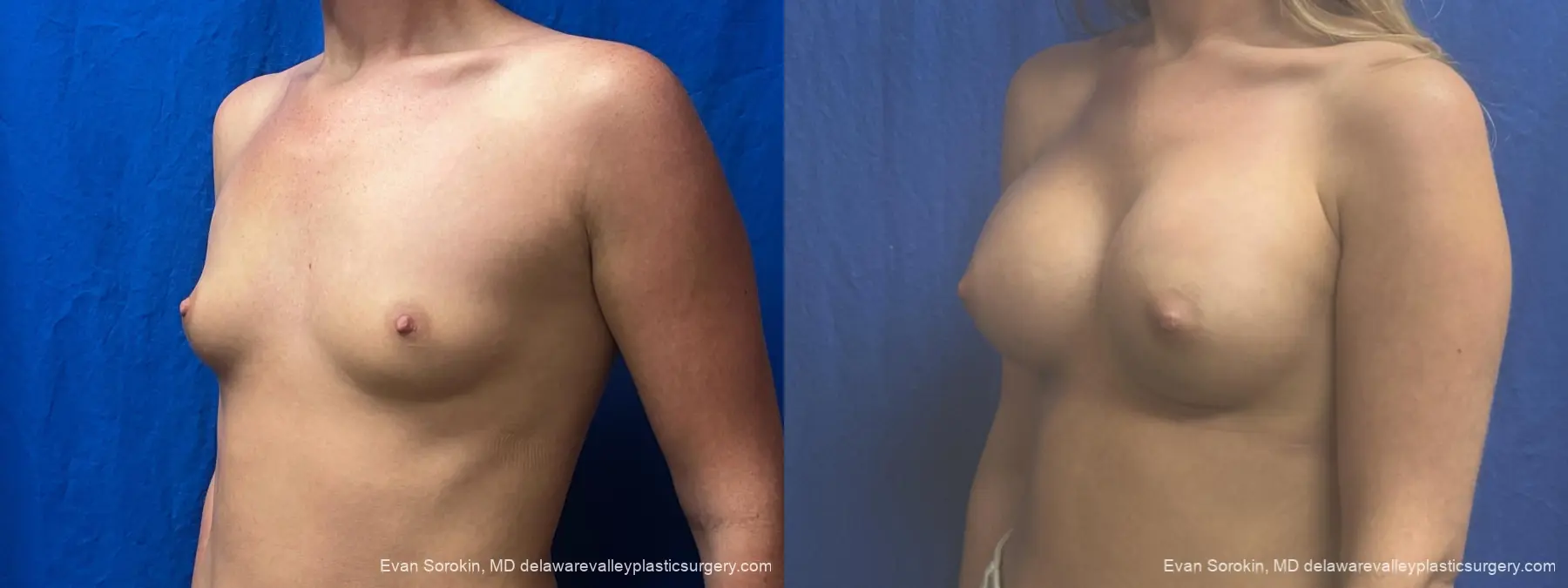 Breast Augmentation: Patient 328 - Before and After 4