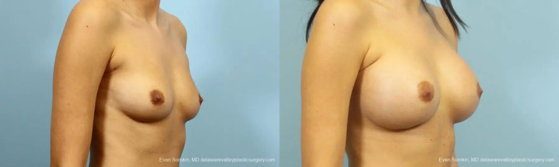 Philadelphia Breast Augmentation 9195 - Before and After 2