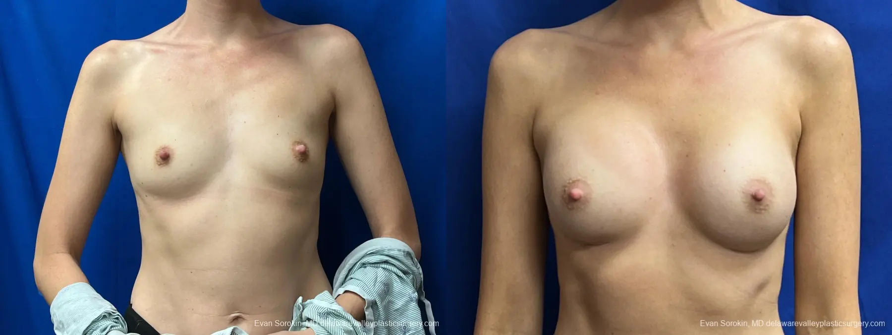 Breast Augmentation: Patient 243 - Before and After 1