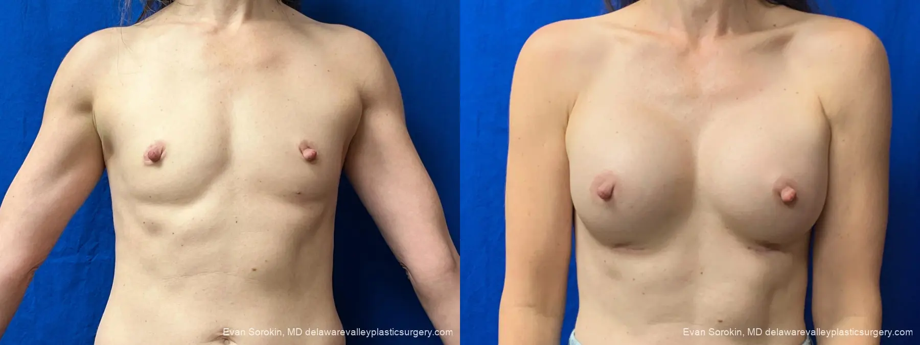 Breast Augmentation: Patient 325 - Before and After 1