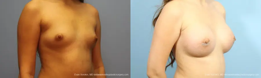 Philadelphia Breast Augmentation 9194 - Before and After 2
