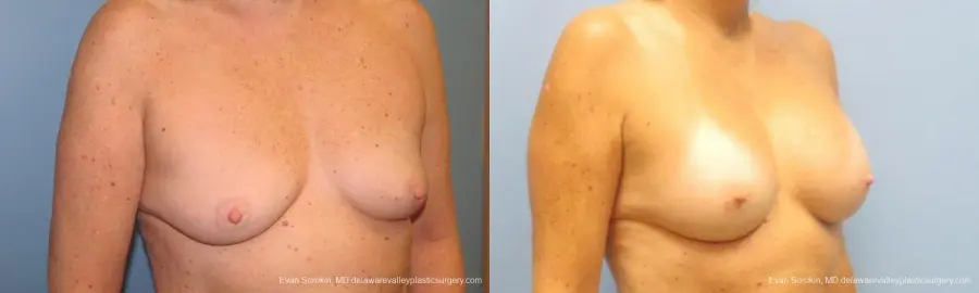 Philadelphia Breast Augmentation 9600 - Before and After 2