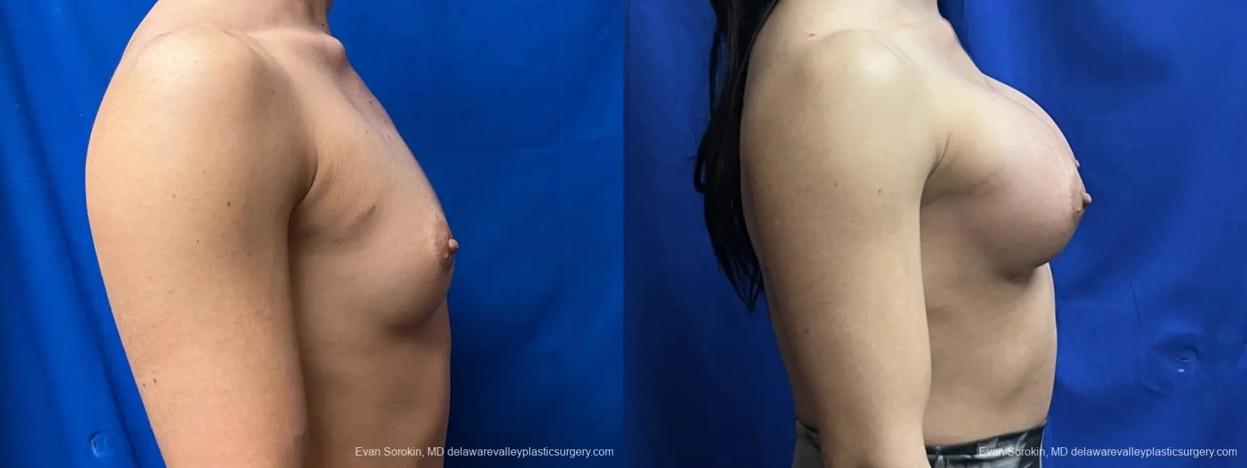 Breast Augmentation: Patient 202 - Before and After 3