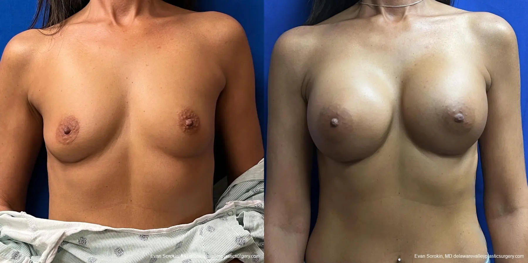 Breast Augmentation: Patient 236 - Before and After 1