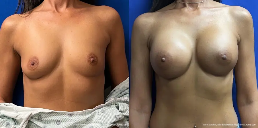 Breast Augmentation: Patient 200 - Before and After 1