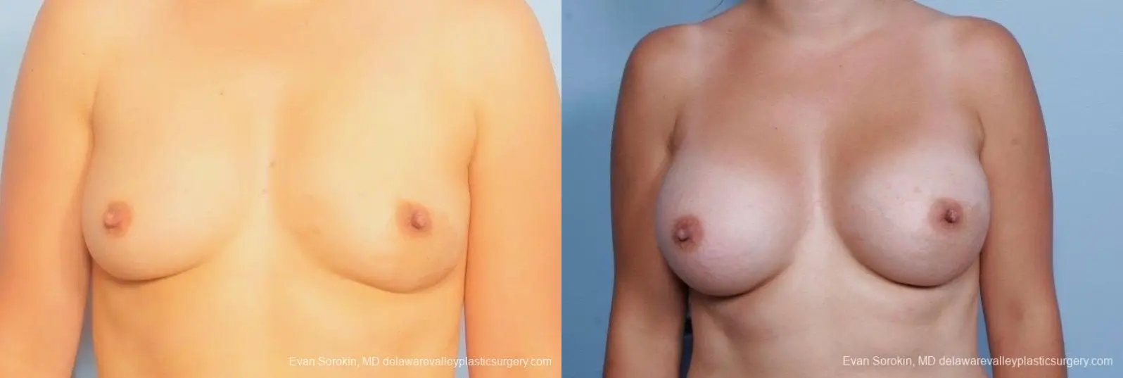 Philadelphia Breast Augmentation 8797 - Before and After 1