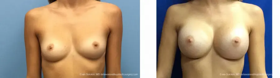 Philadelphia Breast Augmentation 13180 - Before and After 1
