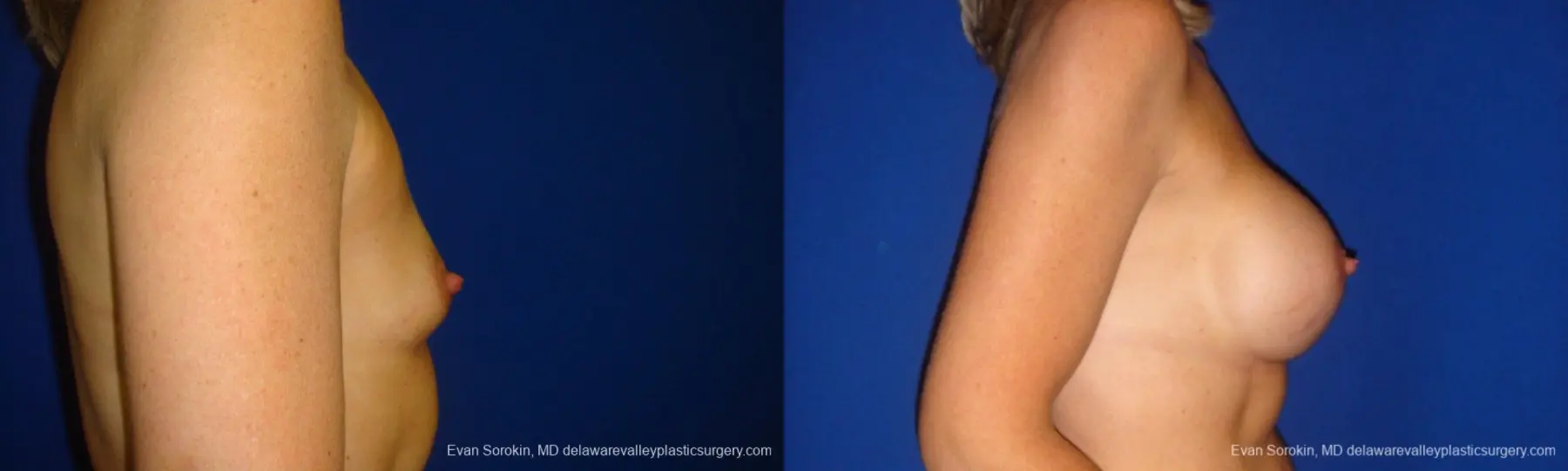 Philadelphia Breast Augmentation 9412 - Before and After 3