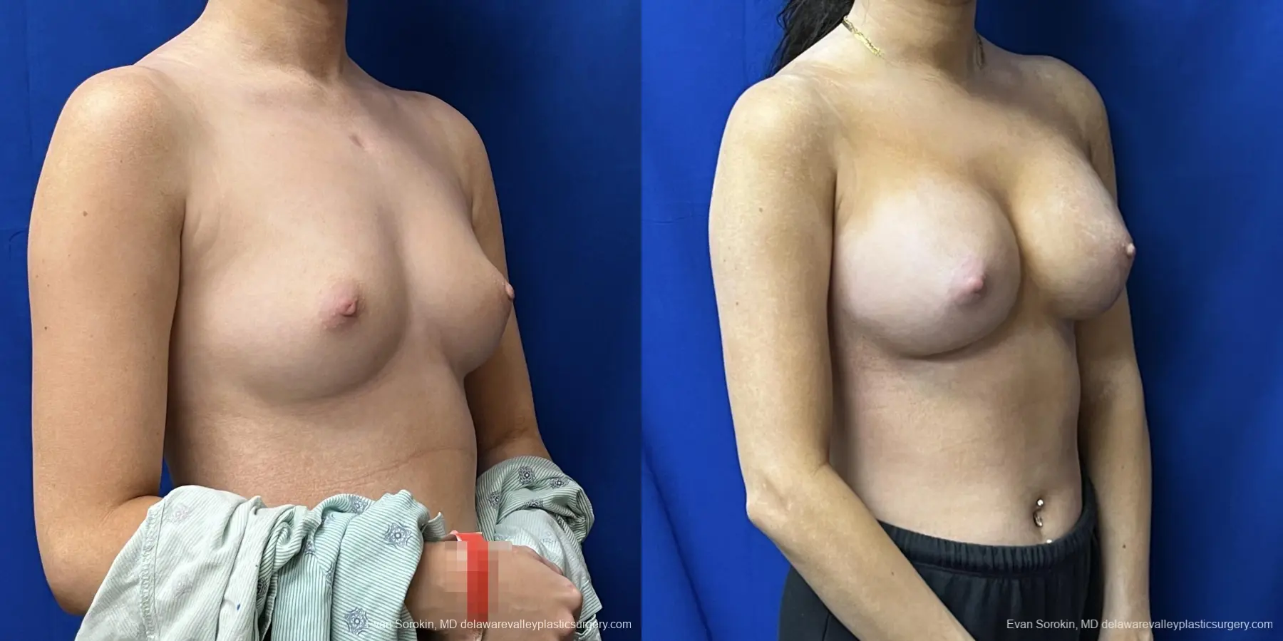 Breast Augmentation: Patient 215 - Before and After 2