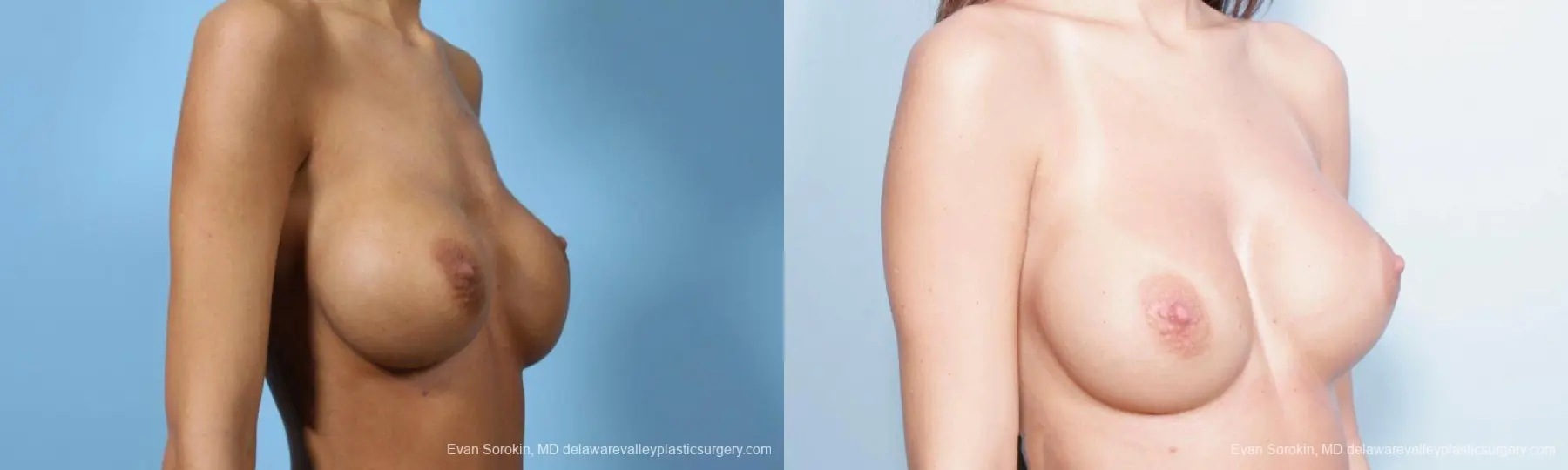 Philadelphia Breast Augmentation 9445 - Before and After 4