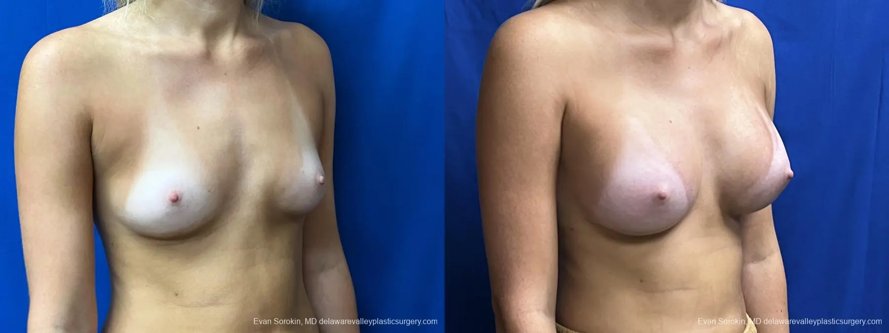 Breast Augmentation: Patient 214 - Before and After 2