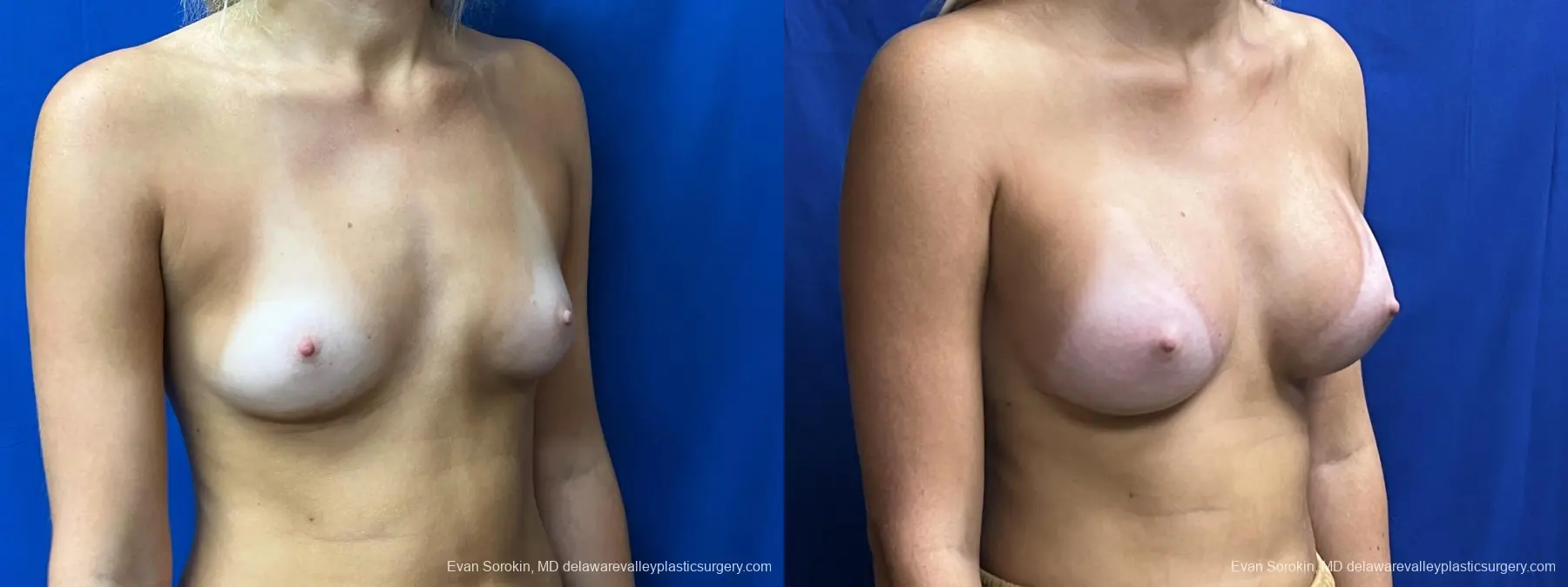 Breast Augmentation: Patient 254 - Before and After 2