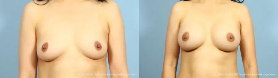 Philadelphia Breast Augmentation 9287 - Before and After 1