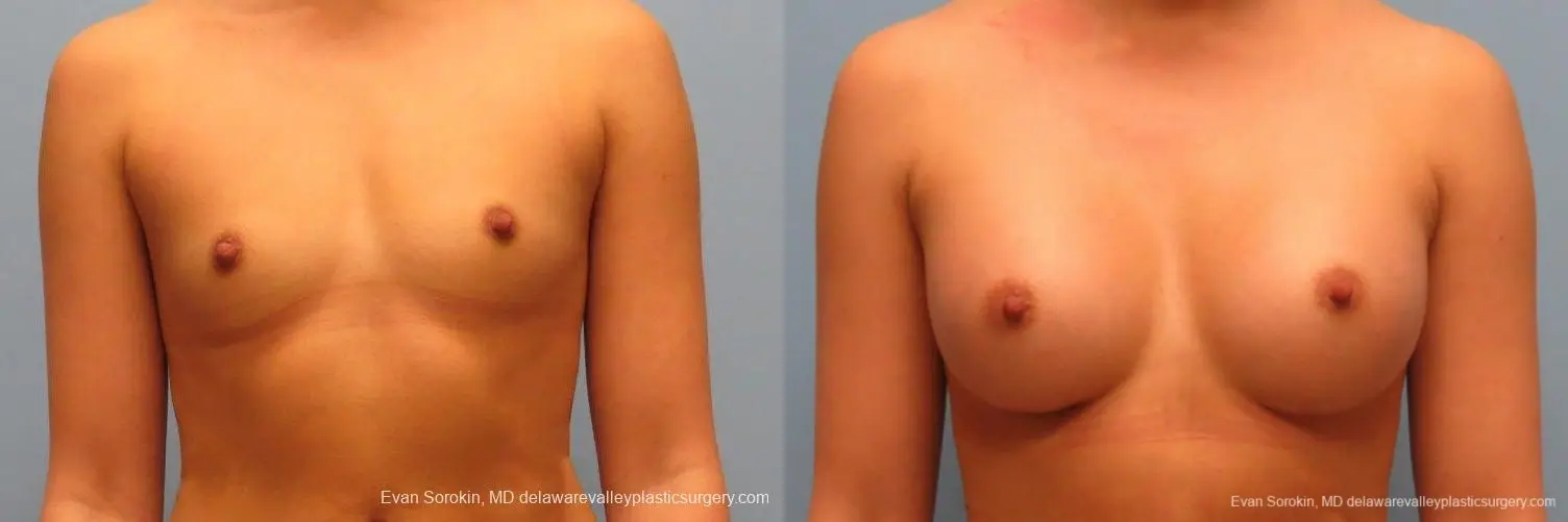 Philadelphia Breast Augmentation 9410 - Before and After 1