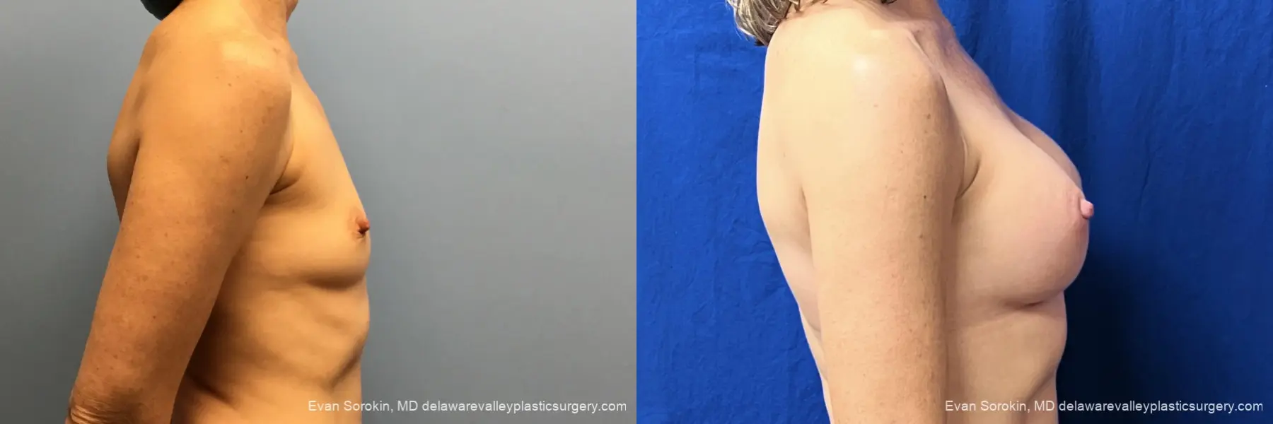 Breast Augmentation: Patient 6 - Before and After 3