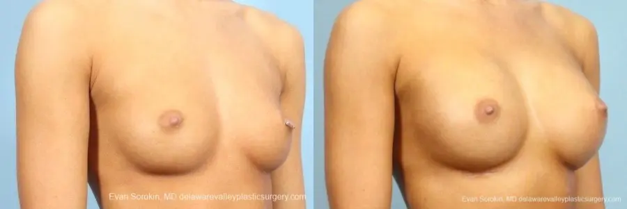 Philadelphia Breast Augmentation 8769 - Before and After 2